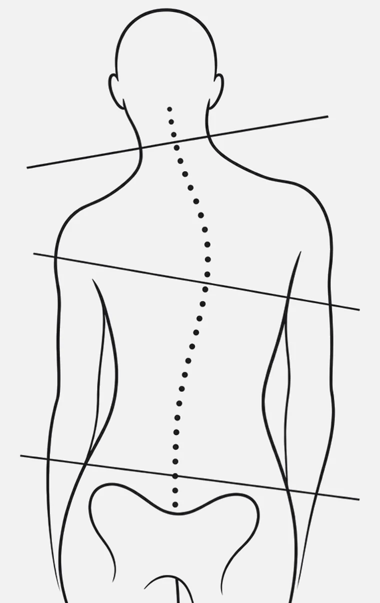 Postural misalignment — shoulder, pelvis and spinal tilt assessment, Motion & Spine